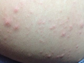 青少年皮炎是怎么引起的