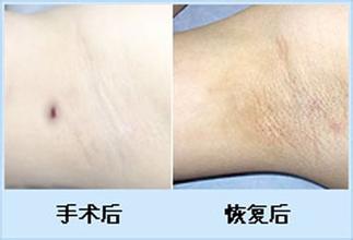 腋臭患者在饮食上的三大禁忌: