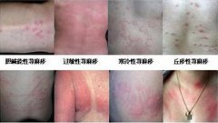 郑州荨麻疹的分类有哪些