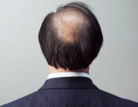 呼和浩特肤康脱发要着重治疗吗?