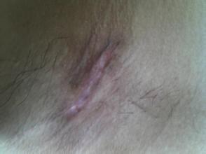 呼和浩特肤康狐臭是怎么导致的