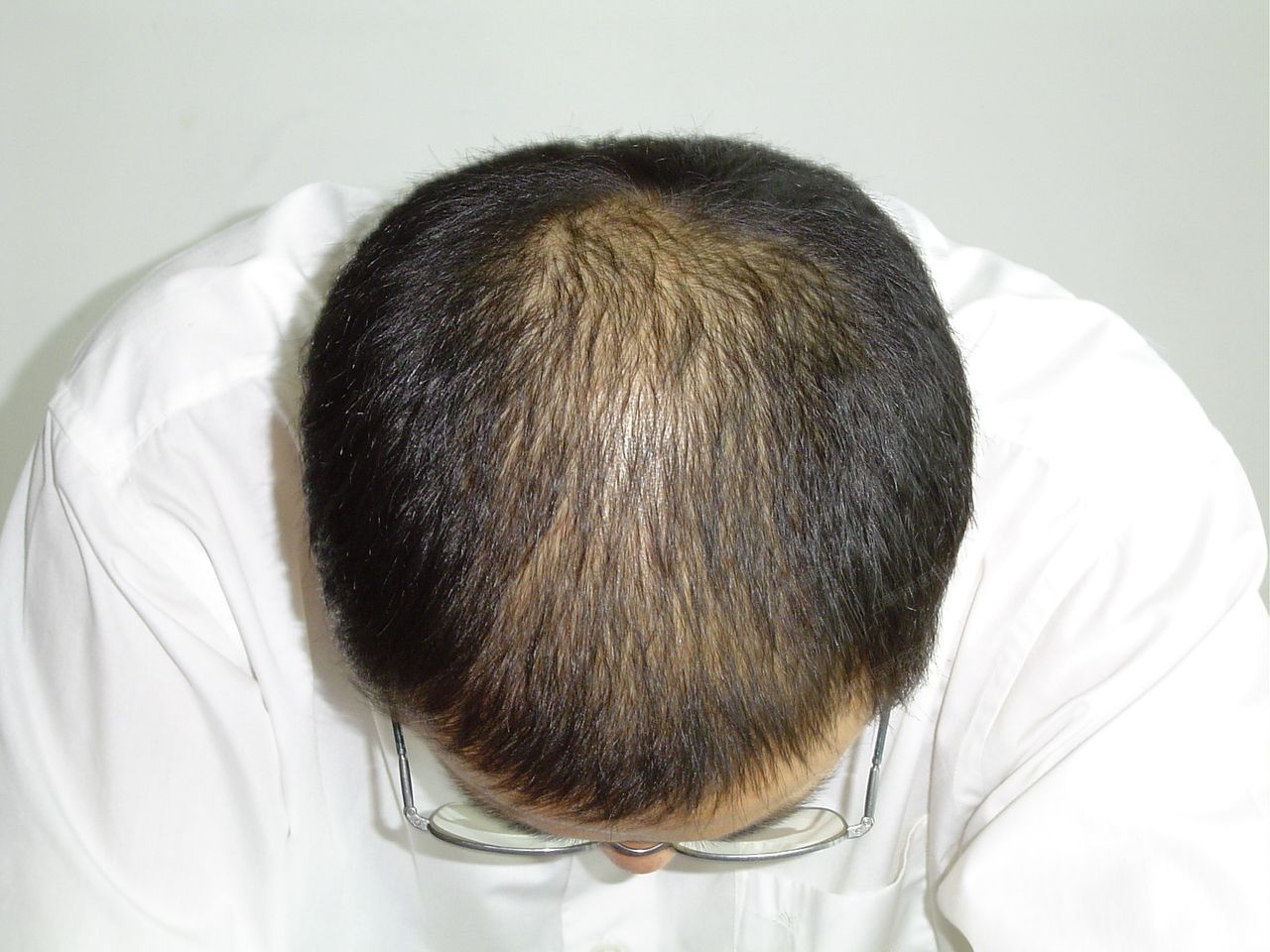 郑州肤康脱发严重的主要原因有哪些？