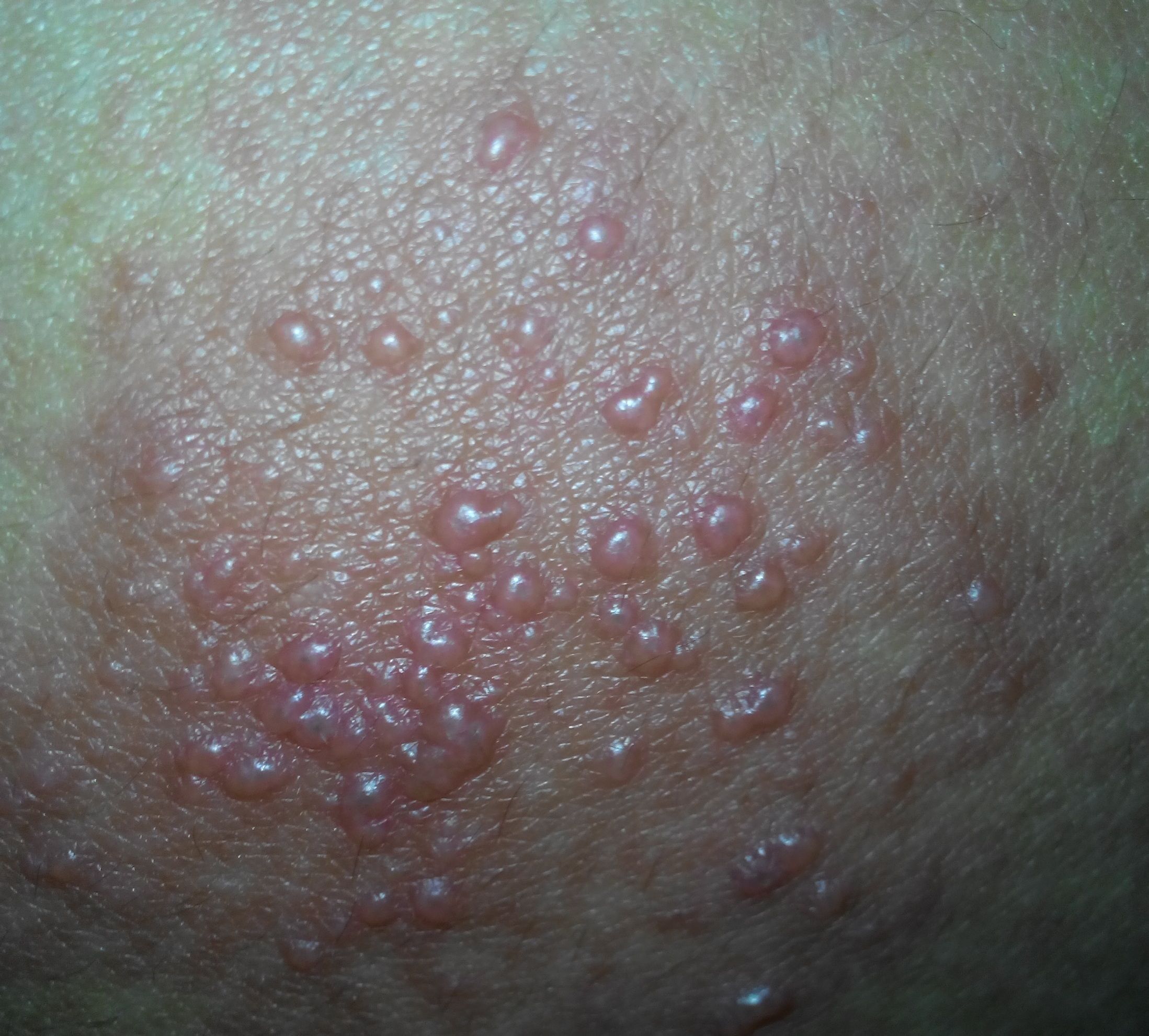 郑州肤康治疗湿疹好的方案有哪些呢？