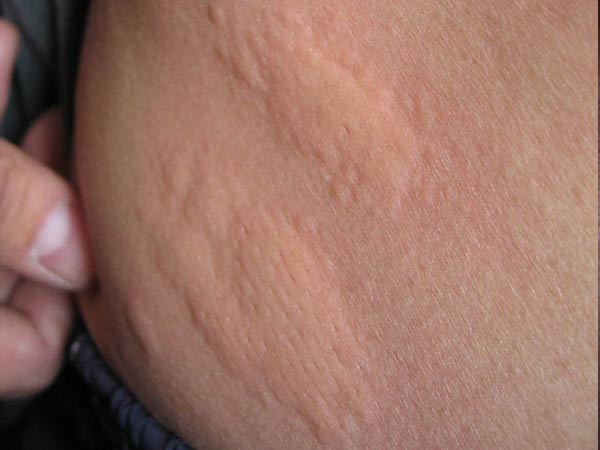 郑州肤康荨麻疹是怎么引起的呢？