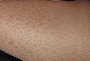 呼和浩特肤康鱼鳞病的危害有哪些?