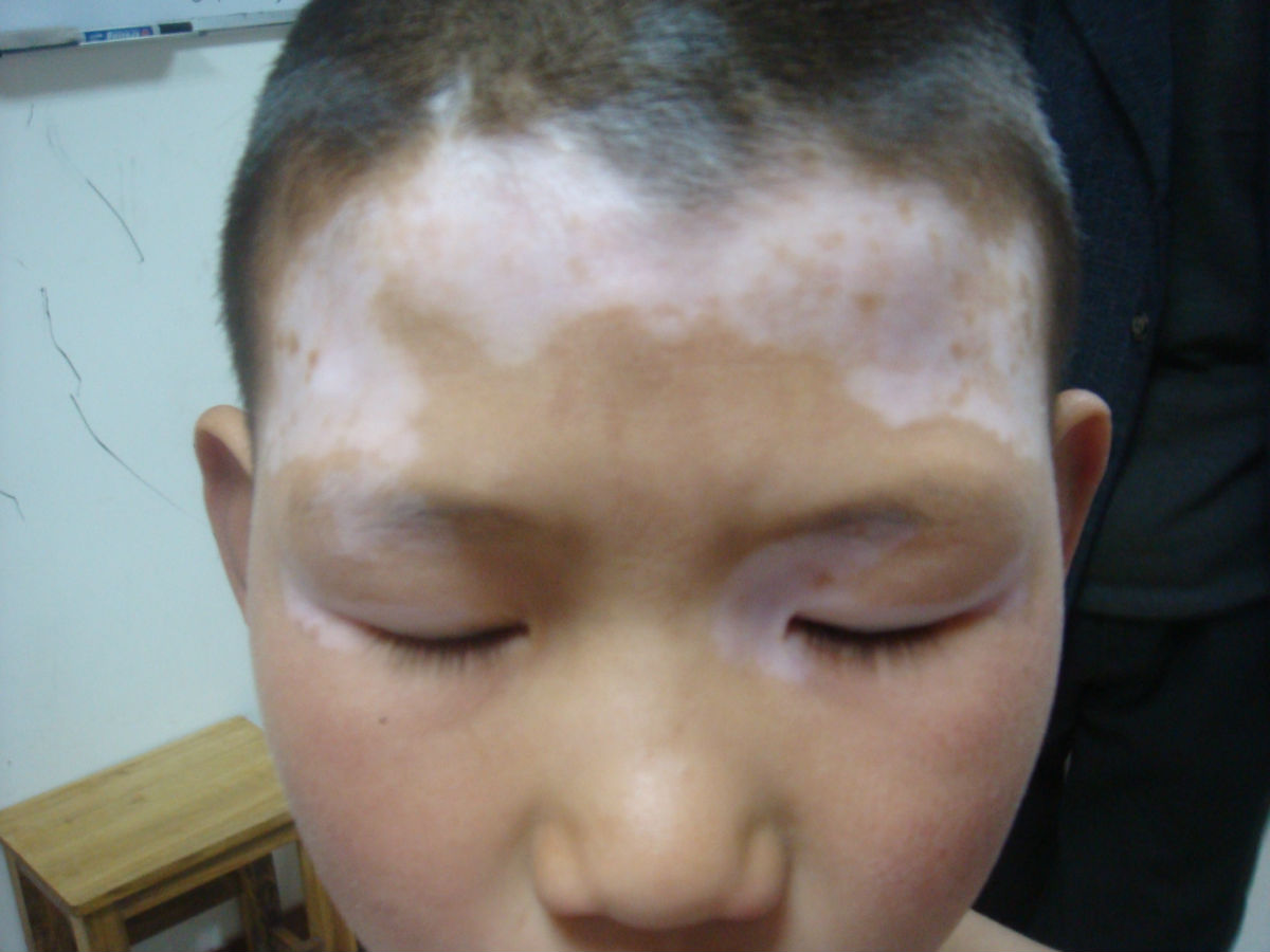 呼和浩特肤康如何预防毛囊型白癜风?