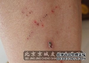 皮肤瘙痒的偏方