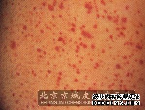 皮肤瘙痒起红疹怎么办