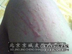 夏季皮肤瘙痒的治疗方法