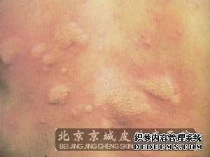 洗澡不当容易发生皮肤瘙痒