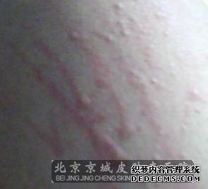 肛门皮肤瘙痒症如何用药