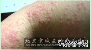 胳膊发红出现皮肤瘙痒