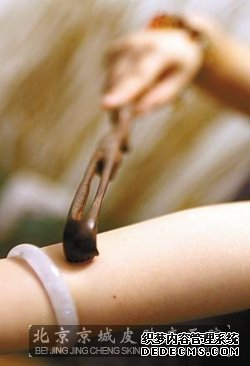 治疗皮肤瘙痒的方法