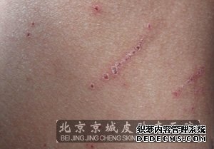 治疗皮肤瘙痒症的误区有哪些