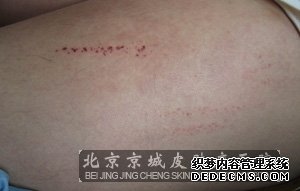 皮肤瘙痒症的治疗措施都有哪些